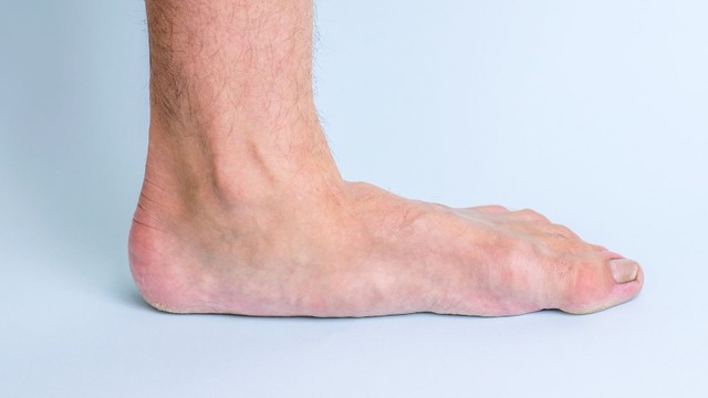 bai-viet/hinh-anh-ban-chan-bet-so-voi-ban-chan-binh-thuong.html