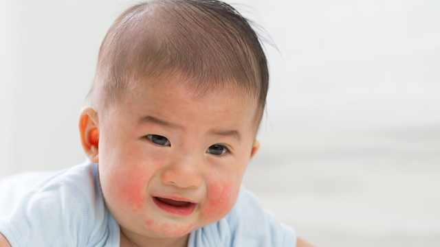 bai-viet/hinh-anh-be-bi-di-ung-dam-sua-bo-va-cach-khac-phuc-tinh-trang-nay.html