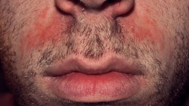 bai-viet/hinh-anh-benh-nam-da-mat-dau-hieu-nhan-biet-benh-nam-da-mat.html