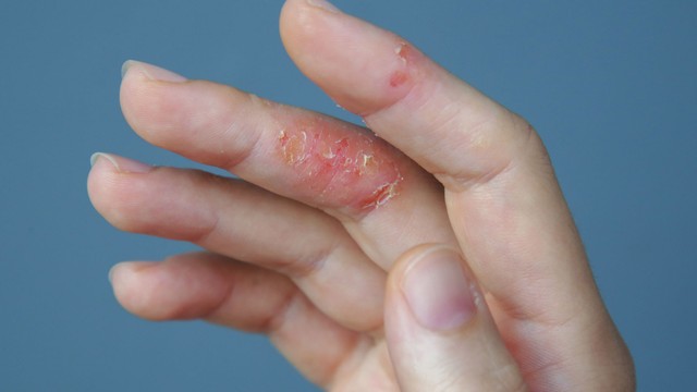 bai-viet/hinh-anh-benh-nam-to-dia-tung-loai-de-nhan-biet-va-dieu-tri.html