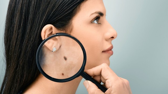 bai-viet/dau-hieu-nhan-biet-hinh-anh-not-ruoi-ung-thu-hac-to.html