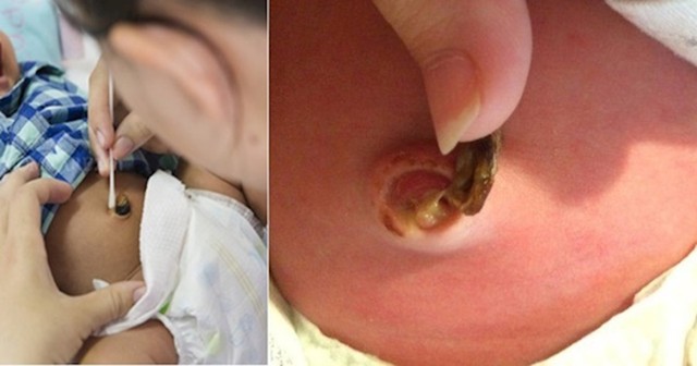 bai-viet/hinh-anh-ron-tre-so-sinh-bi-nhiem-trung-cung-cach-dieu-tri-ma-me-can-biet-61305.html