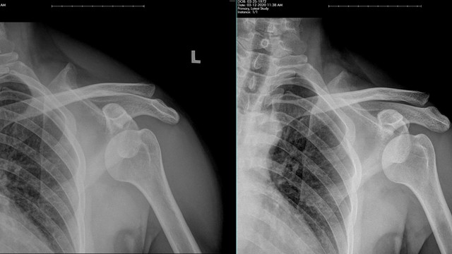 bai-viet/hinh-anh-trat-khop-vai-va-mot-so-truong-hop-chi-dinh-chup-x-quang-khop-vai.html