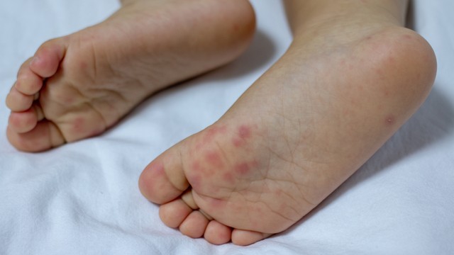 bai-viet/hinh-anh-va-dau-hieu-tay-chan-mieng-nhe-tay-chan-mieng-cap-do-1.html