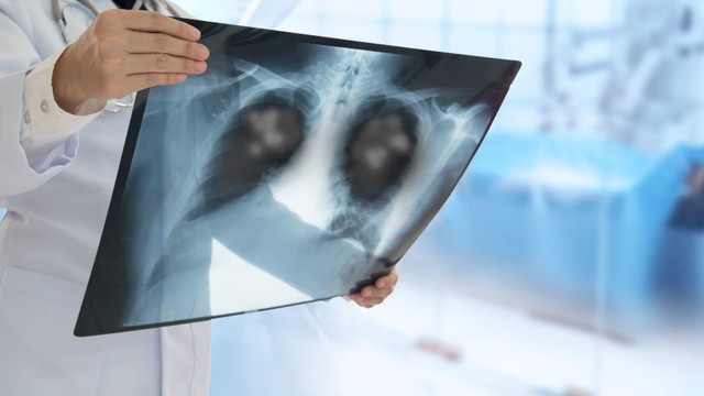 bai-viet/giai-ma-hinh-anh-viem-phoi-o-tre-em-theo-tung-nguyen-nhan.html