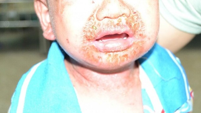 bai-viet/hoi-chung-4-s-hoi-chung-bong-vay-da-do-tu-cau-va-nhung-dieu-can-biet.html