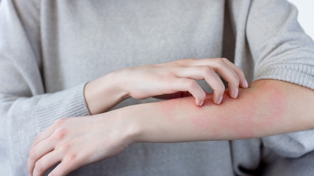 Hội chứng Churg-Strauss