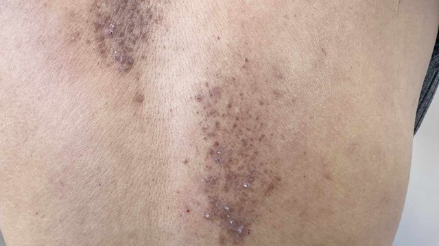 Hội chứng Abercrombie: Triệu chứng, nguyên nhân và cách điều trị 1