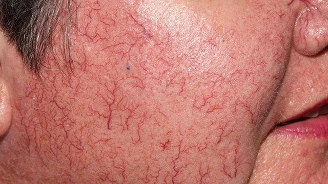 bai-viet/hoi-chung-carcinoid-la-gi-nguyen-nhan-va-bien-chung-khi-mac-hoi-chung-carcinoid-56360.html