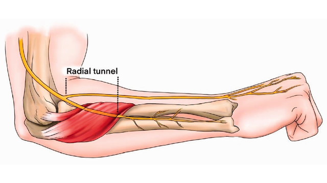 benh/hoi-chung-duong-ham-xuong-quay.html
