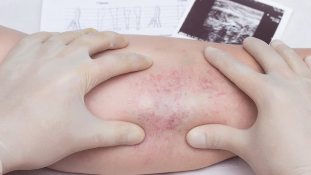 bai-viet/hoi-chung-may-thurner-la-gi-dau-hieu-cua-hoi-chung-may-thurner.html