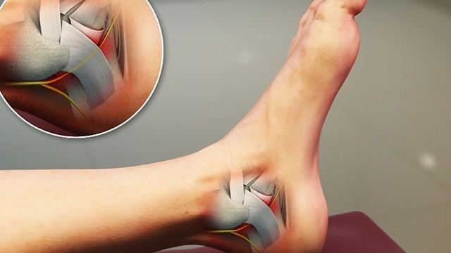 bai-viet/hoi-chung-ong-co-chan-la-gi-nguyen-nhan-dau-hieu-nhan-biet-va-cach-phong-ngua-benh.html