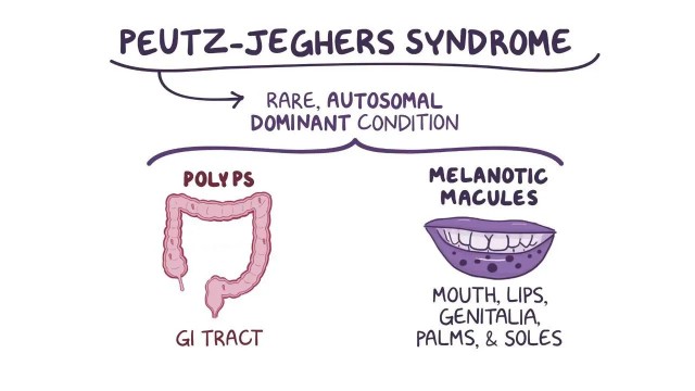 bai-viet/hoi-chung-peutz-jeghers-nguyen-nhan-va-cach-chan-doan-54061.html