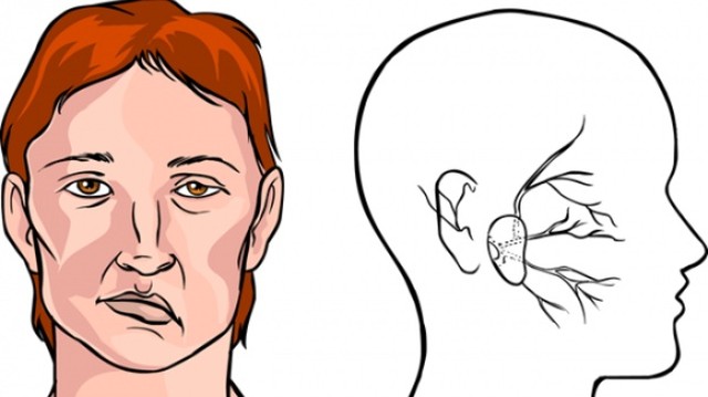 bai-viet/hoi-chung-weber-nguyen-nhan-trieu-chung-cach-dieu-tri-va-phong-ngua-70417.html