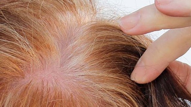 bai-viet/hoi-dau-o-nu-nguyen-nhan-dieu-tri-va-nhung-dieu-can-biet.html