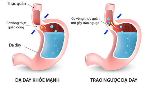 bai-viet/hoi-luu-da-day-thuc-quan-la-gi-nguyen-nhan-trieu-chung-va-cach-phong-ngua.html