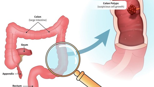 bai-viet/khuyen-cao-ve-sang-loc-ung-thu-dai-truc-trang-cua-hiep-hoi-tieu-hoa-hoa-ky.html