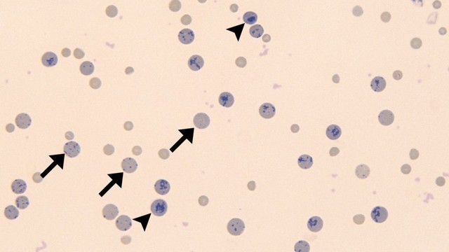 Hồng cầu lưới là gì? Vai trò và những vấn đề sức khỏe liên quan