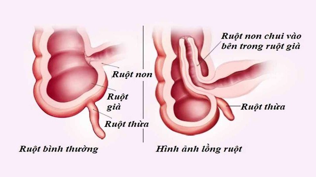 benh/long-ruot-125.html