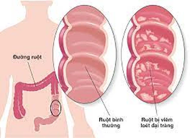 benh/ly-truc-trung-do-shigella-dysenteriae-195.html