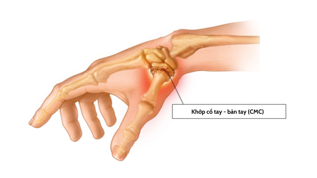 benh/viem-khop-ngon-tay-cai.html