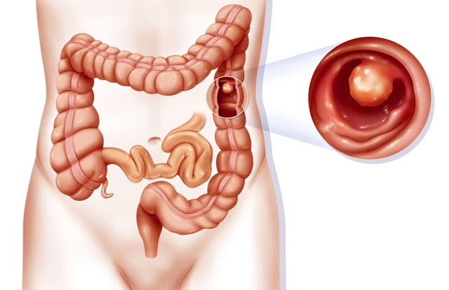benh/polyp-truc-trang-207.html