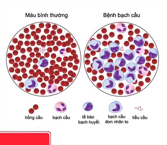 benh/tang-bach-cau-don-nhan-266.html