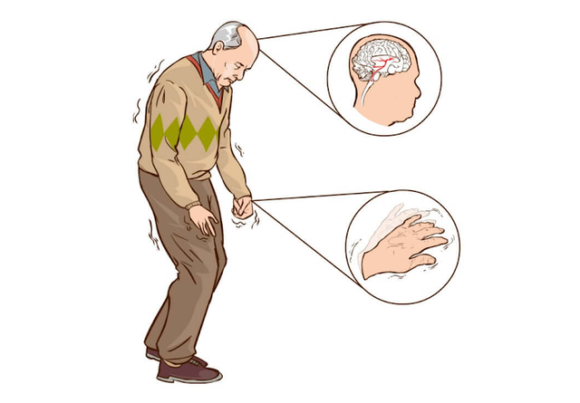 benh/parkinson-thu-phat-28.html