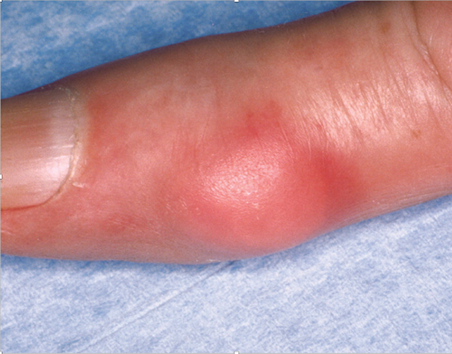 benh/gut-564.html