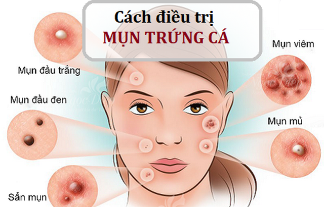 bai-viet/5-cach-dieu-tri-mun-trung-ca-tai-nha-cuc-ky-hieu-qua-48737.html