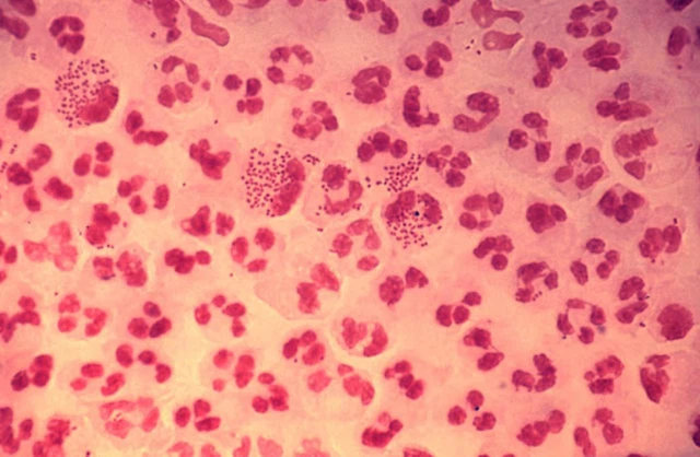 benh/nhiem-lau-cau-62.html