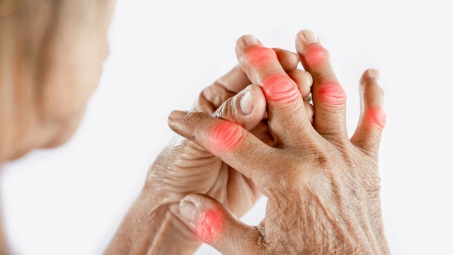 6 loại trái cây khô dành cho người axit uric cao giúp ngăn ngừa bệnh gout và sỏi thận