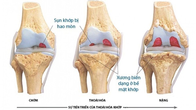 bai-viet/nhung-nguyen-nhan-thoai-hoa-khop-ban-can-biet-de-phong-benh-hieu-qua.html