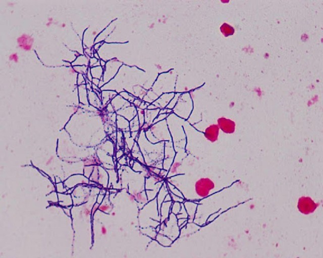benh/nhiem-nocardia-74.html