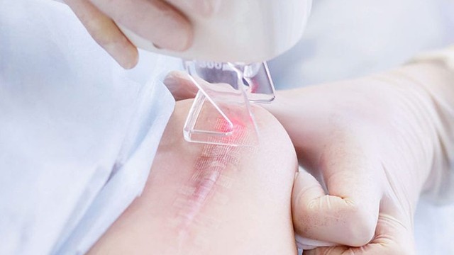 bai-viet/9-dieu-quan-trong-can-biet-khi-dieu-tri-seo-bang-laser.html