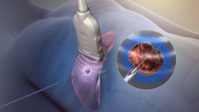 bai-viet/ablation-la-gi-ung-dung-trong-y-hoc-va-cach-thuc-hien.html