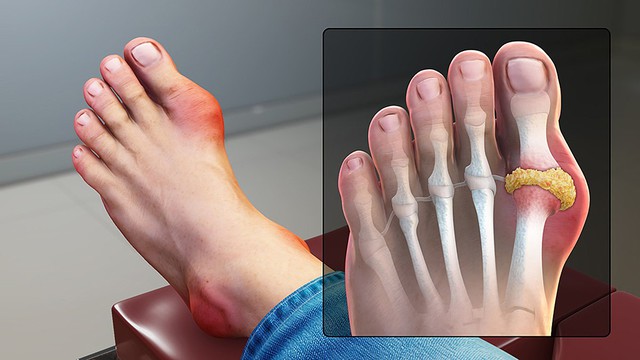 bai-viet/benh-gout-an-oc-duoc-khong-benh-gout-nen-an-gi-va-kieng-gi.html