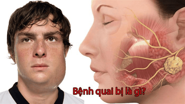 bai-viet/cach-chua-benh-quai-bi-nhanh-nhat-va-nhung-bien-phap-phong-ngua.html