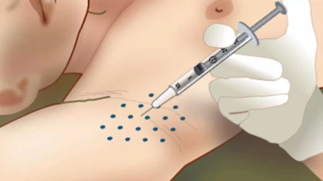 bai-viet/tiem-botox-tri-hoi-nach-co-hieu-qua-khong-uu-va-nhuoc-diem-khi-tiem-botox.html