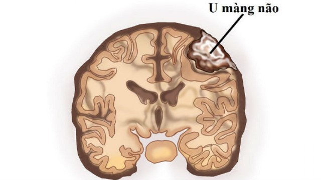 bai-viet/u-mang-nao-co-nen-mo-khong-chi-phi-va-bien-chung-sau-phau-thuat.html