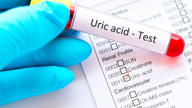 bai-viet/cac-buoc-xet-nghiem-acid-uric-ban-can-biet.html