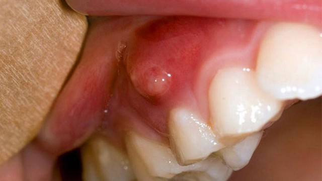 bai-viet/trieu-chung-va-cach-dieu-tri-ap-xe-quanh-chop-rang.html