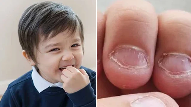 Trẻ hay cắn móng tay là thiếu chất gì? Bổ sung sao cho hiệu quả?