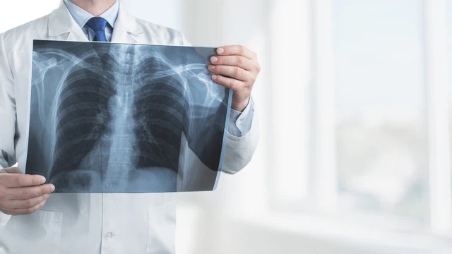Bệnh lao là gì? Những vấn đề cần biết về bệnh lao