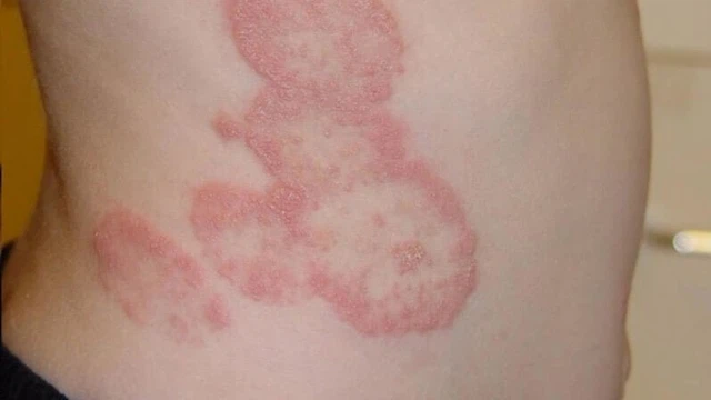 bai-viet/benh-nam-dermatophytosis-la-benh-gi-trieu-chung-benh-va-cach-dieu-tri-ra-sao.html