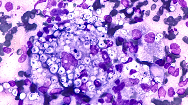 bai-viet/benh-nam-histoplasmosis-la-benh-gi-trieu-chung-va-phuong-phap-dieu-tri.html