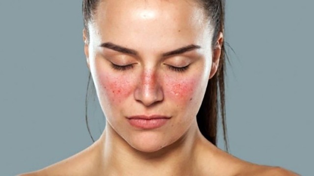 bai-viet/benh-nhan-bi-lupus-ban-do-co-nen-lay-chong.html