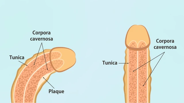 Bệnh Peyronie là gì? Những vấn đề cần biết về bệnh Peyronie 1