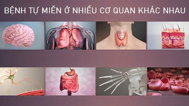 bai-viet/benh-tu-mien-co-nguy-hiem-khong.html