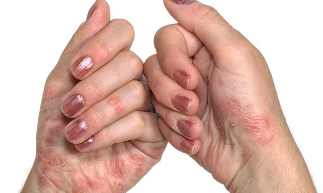 bai-viet/benh-vay-nen-sung-o-tay-40105.html